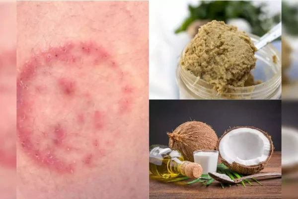 Natural Home Remedies for Fungal Infections