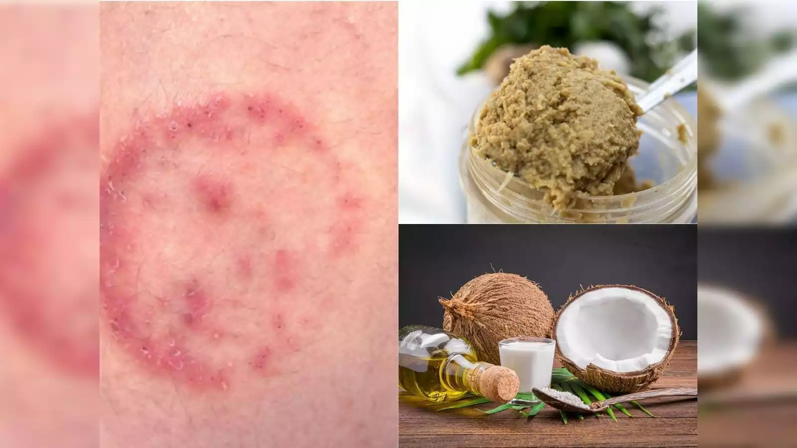 Natural Home Remedies for Fungal Infections