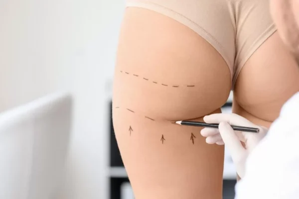 Best Aesthetic Clinic in Dubai Understanding the Cost of Butt Fillers