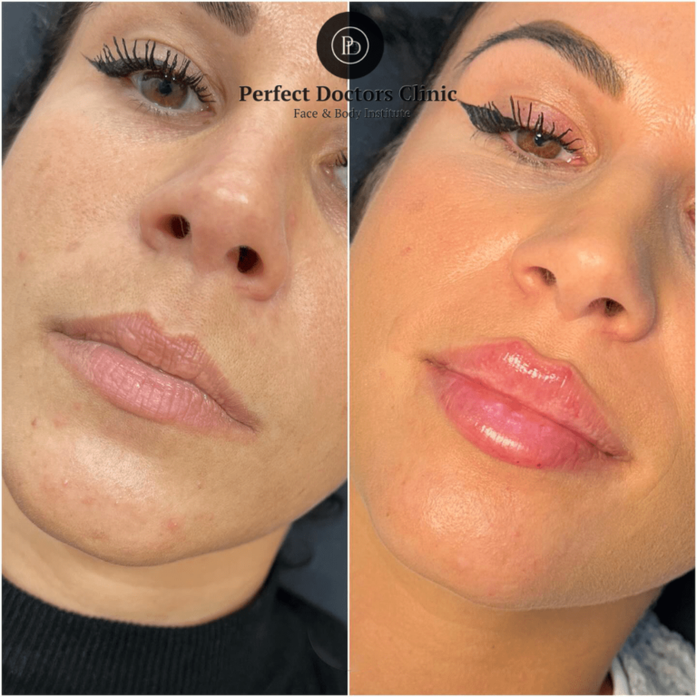 Juvederm Fillers