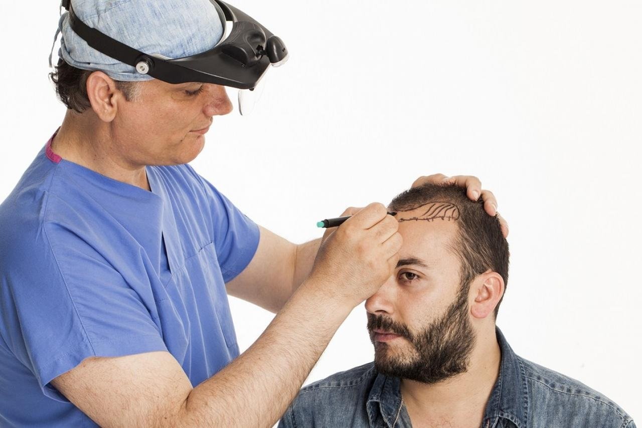 تكلفة زراعة الشعر