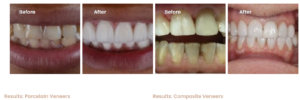 dental veneers wimbledon