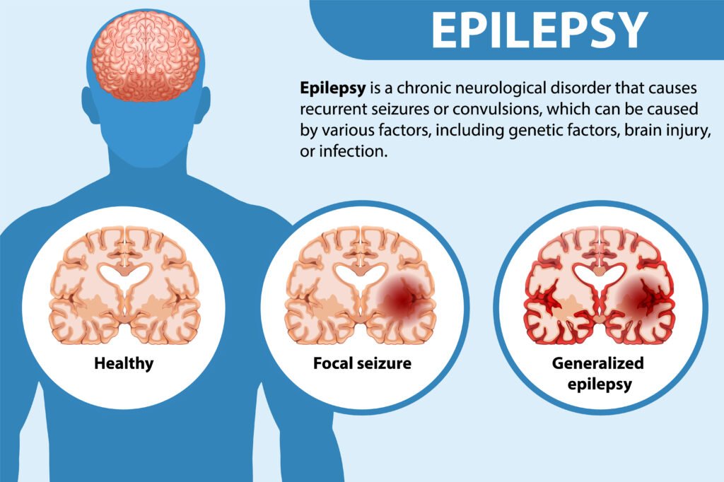 RamaHospital-Causes and Types of Epilepsy