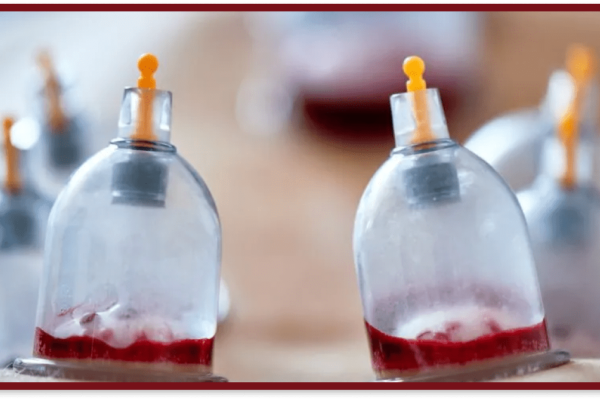 hijama