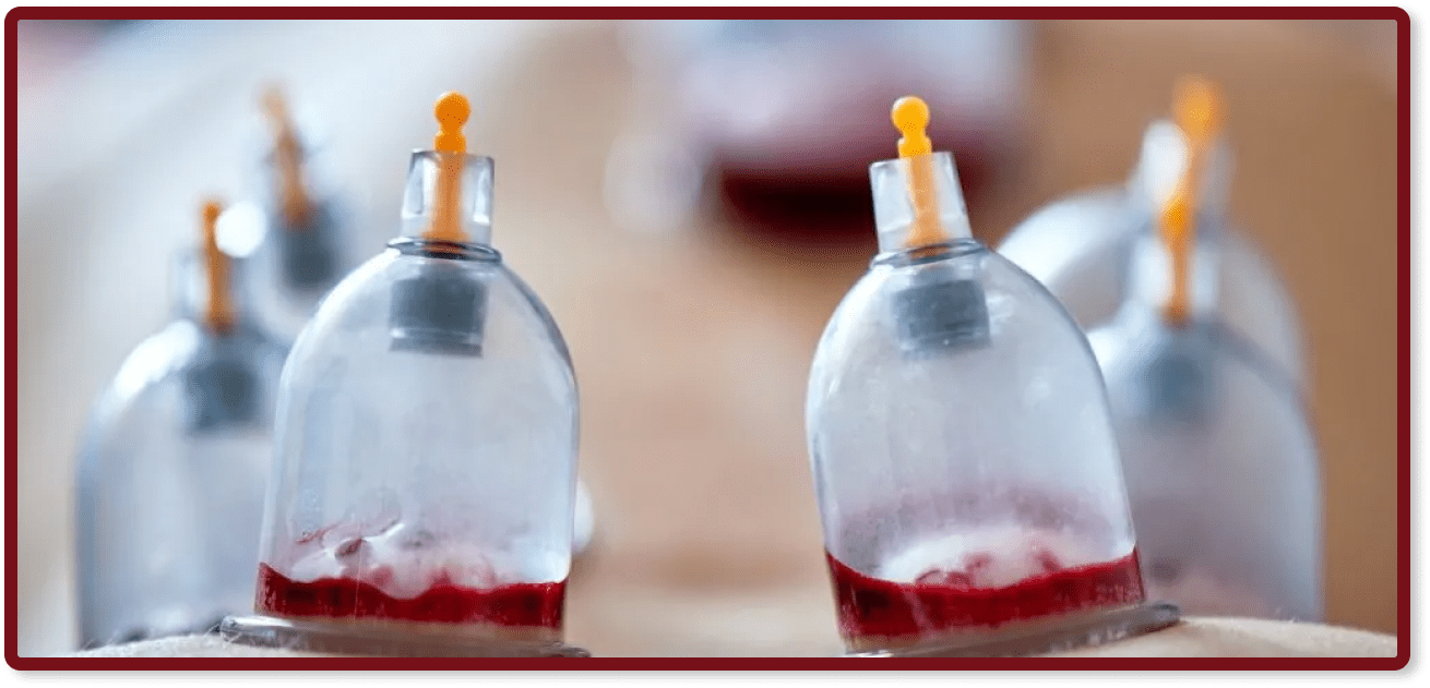 hijama