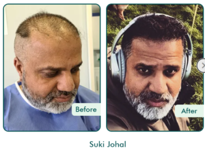 fue hair transplant London