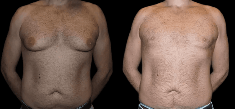 male breast reduction with before and after photos