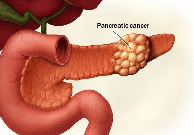 Understanding Pancreas Stone Symptoms and Treatment Options