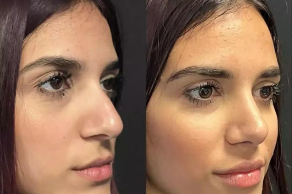 Rhinoplasty in Dubai: Achieve Your Ideal Nose Shape Today