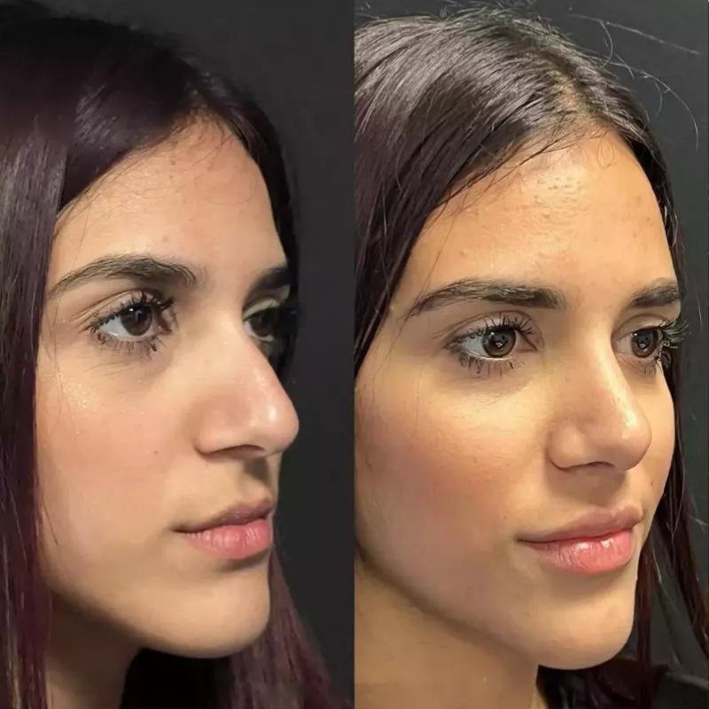 Rhinoplasty in Dubai: Achieve Your Ideal Nose Shape Today