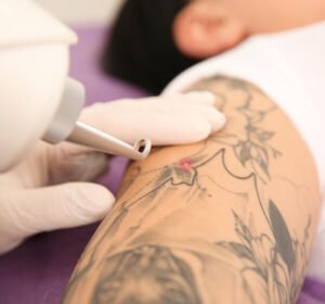 Achieve Clean, Clear Skin with Laser Tattoo Removal 