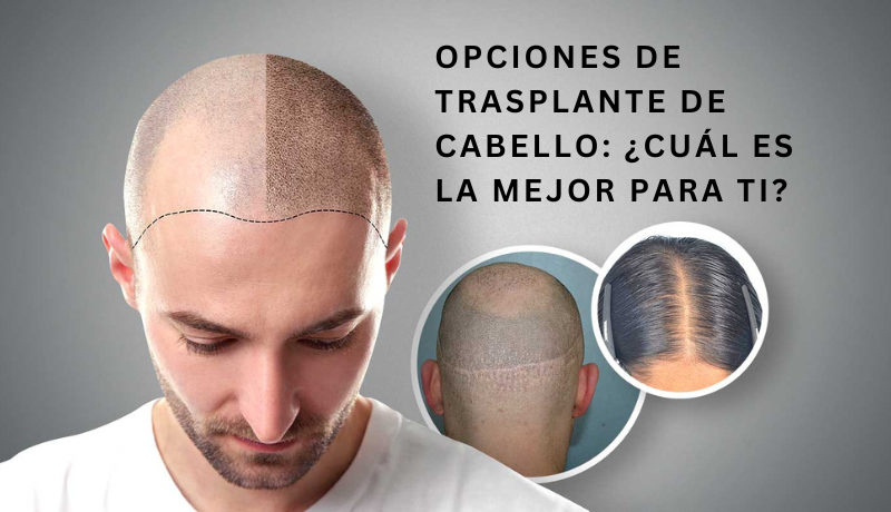 Transplante de cabelo