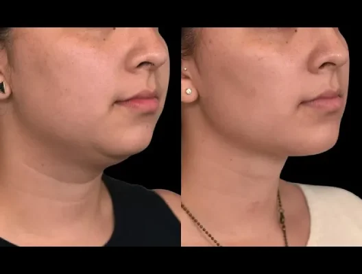 Double Chin Removal