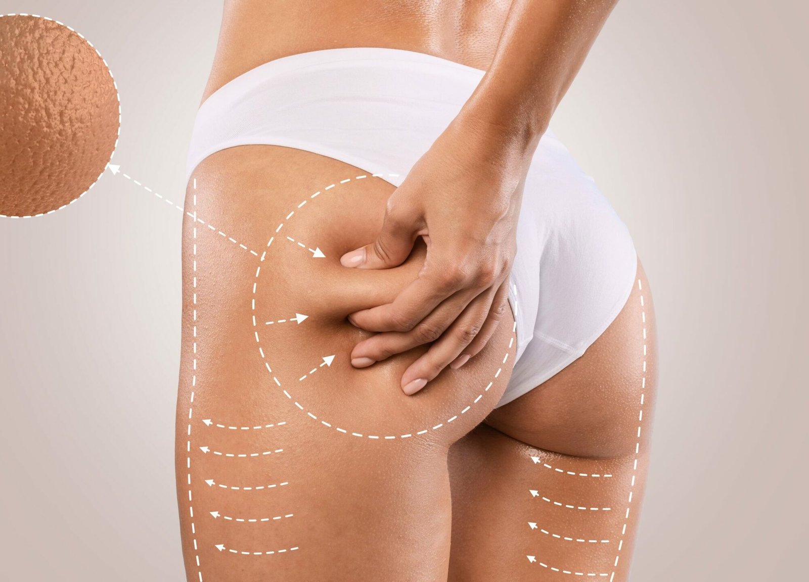 Common Myths About Brazilian Butt Lifts Debunked