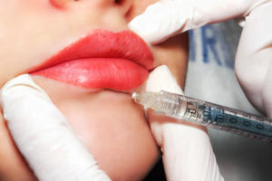 Common Myths About Lip Augmentation Debunked