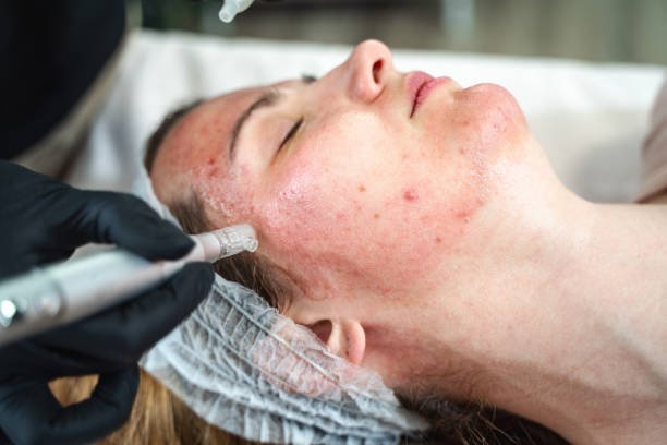 Common Myths About Microneedling Debunked