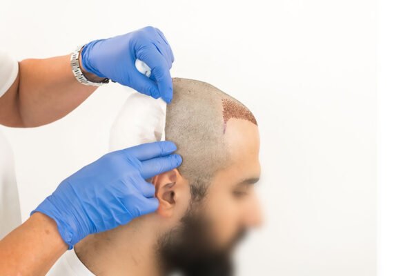 hair transplant cost