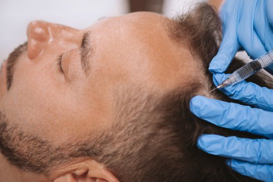 PRP Hair Treatment