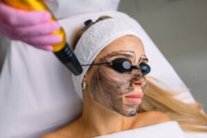 How to Maximize Results from Your Laser Carbon Peel