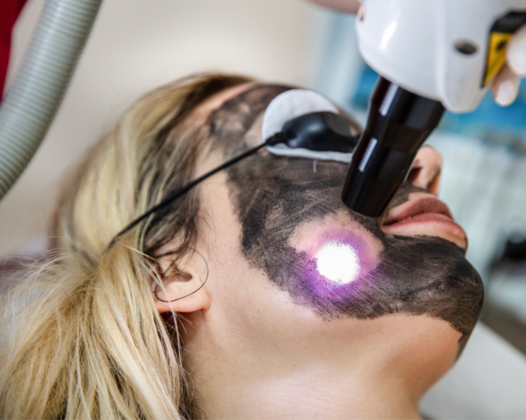 How to Maximize Results from Your Laser Carbon Peel