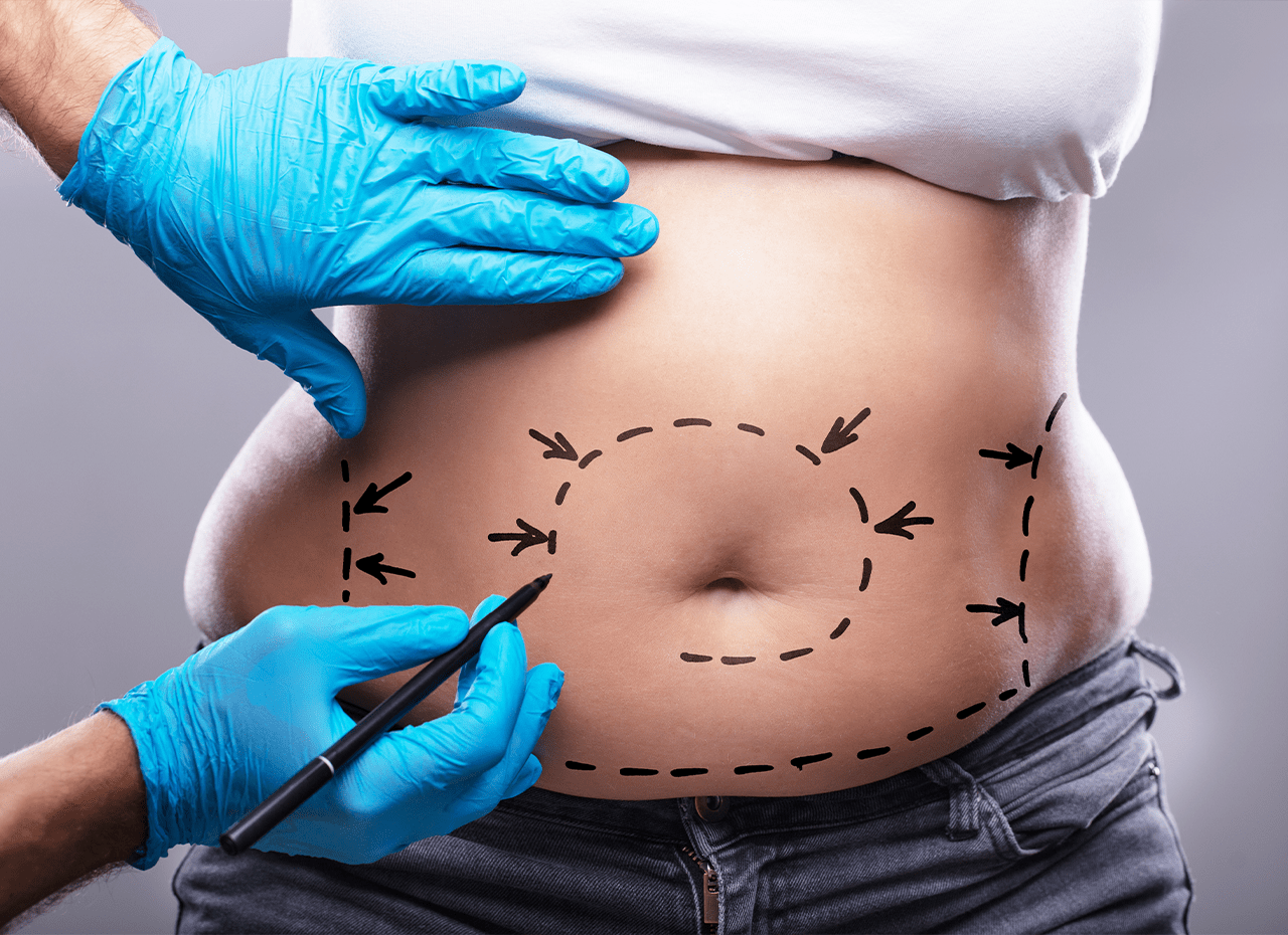 liposuction