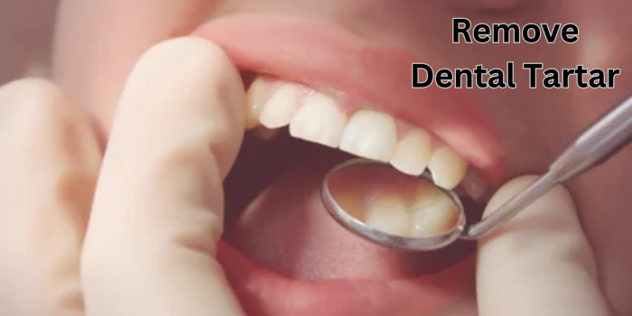 Remove Dental Tartar