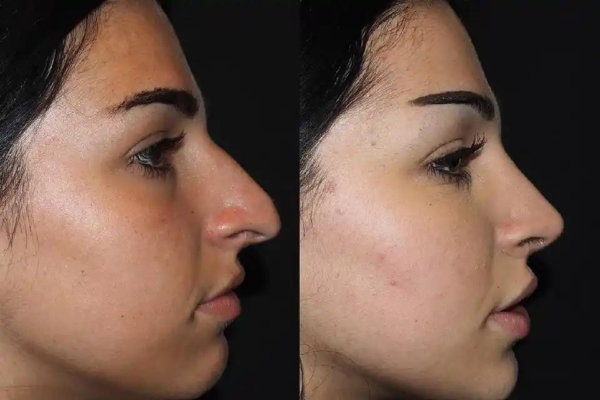 Rhinoplasty Surgery in Dubai: Improve Function & Aesthetics