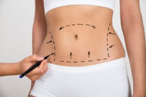 What Are the Benefits of Liposuction?