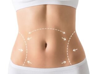 Who is an Ideal Candidate for a Mini Tummy Tuck?