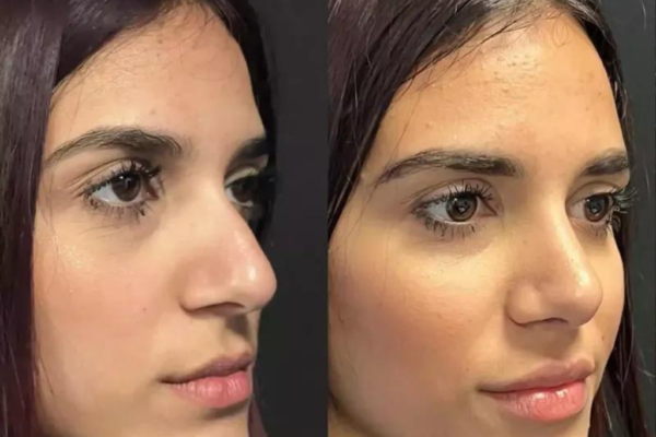 Nose Surgery in Dubai: Expert Surgeons & Results