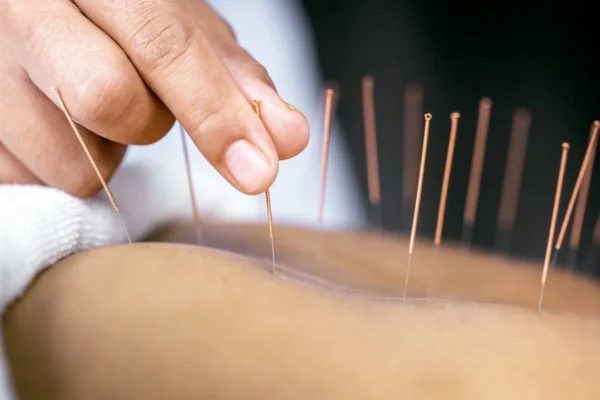 acupuncture therapy in Calgary AB