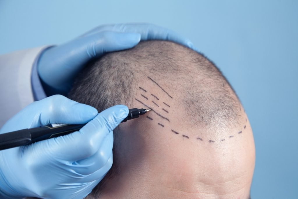 Are Hair Transplants Safe for Everyone?