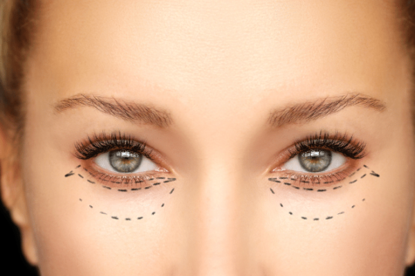 Discover the Best Eyelid Surgery