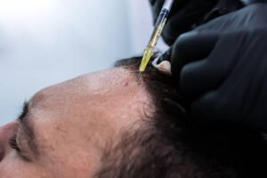 How to Get the Most Out of PRP Hair Treatment