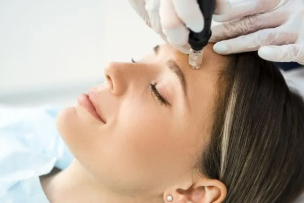 Is Dermapen Microneedling a Permanent Solution in Abu Dhabi