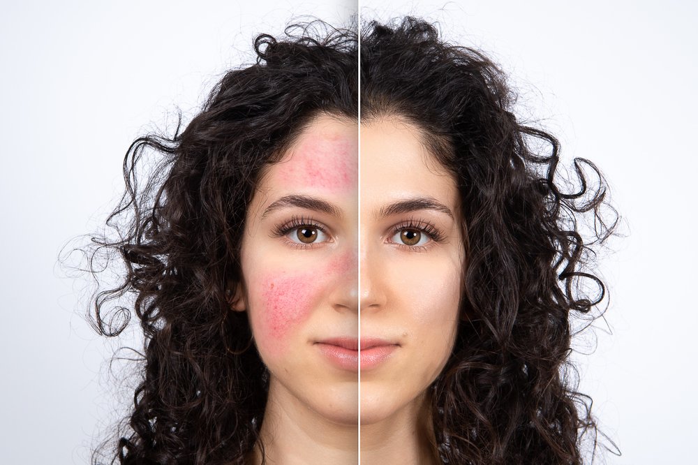 Is There a Quick Recovery from Rosacea Treatment?