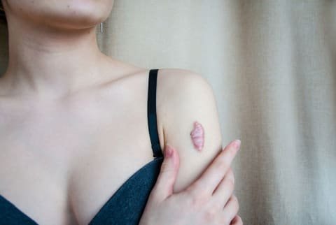 Is There a Recovery Period for Keloid Treatment?