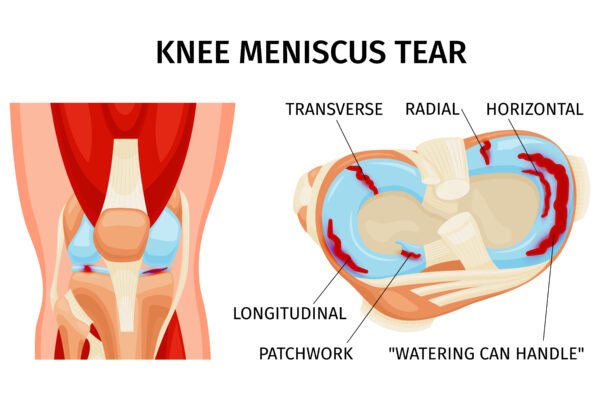 Knee Replacement Treatment In India