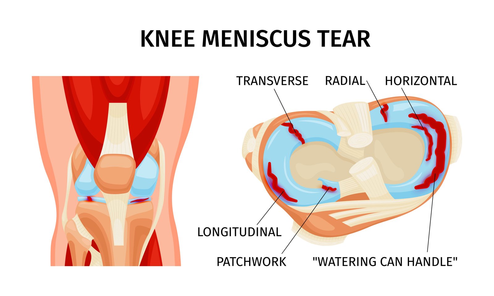 Knee Replacement Treatment In India