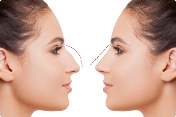 Rhinoplasty in Dubai(تجميل الأنف في دبي)