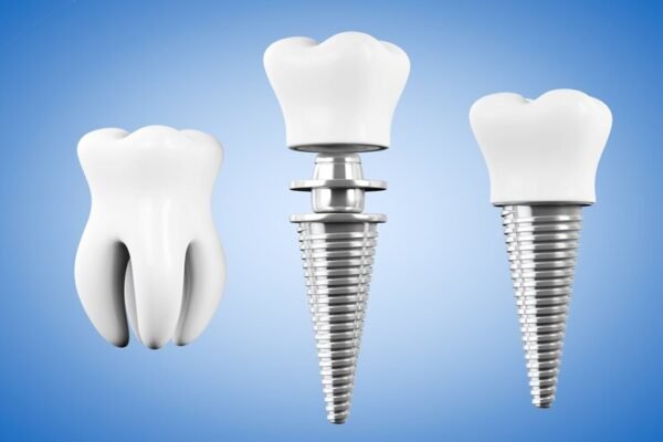 dental implant georgetown ky