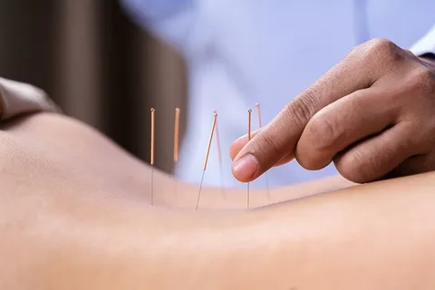 acupuncture therapy services