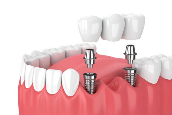 Dental Bridge Replacement at Gentle Dentistry, Irving, TX