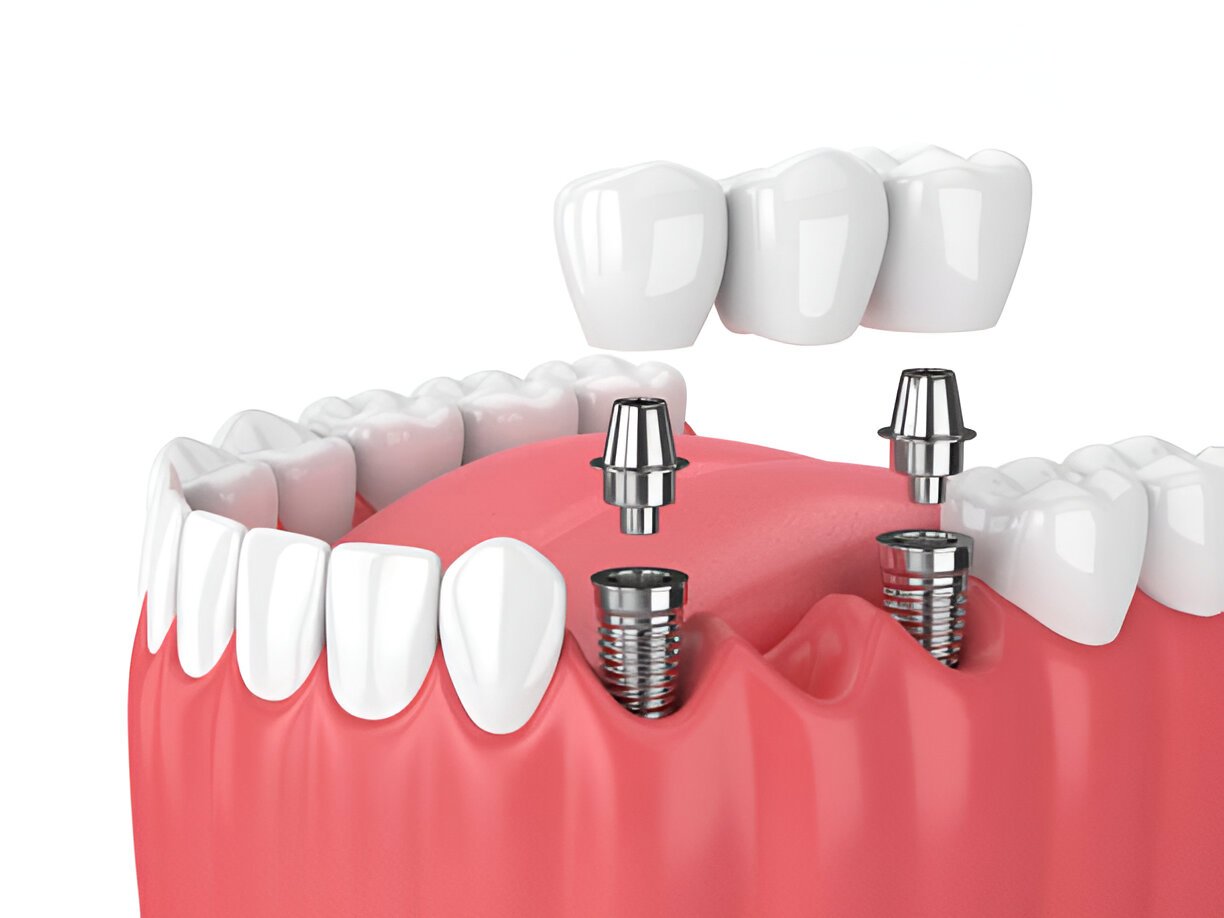 Dental Bridge Replacement at Gentle Dentistry, Irving, TX