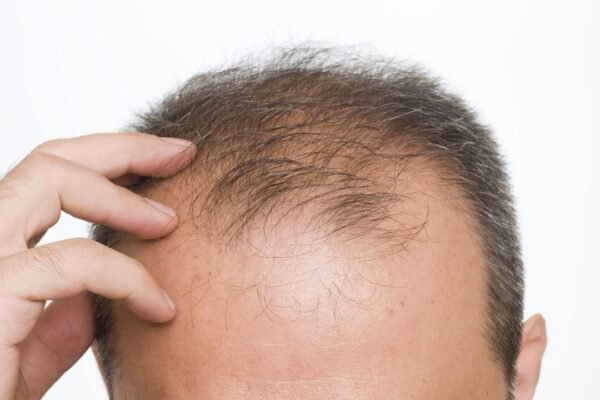 Advanced Technology in Crown Hair Transplants