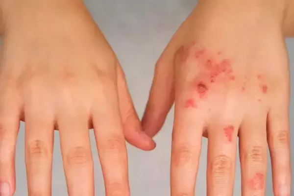 What is the best antibiotic to treat skin infections