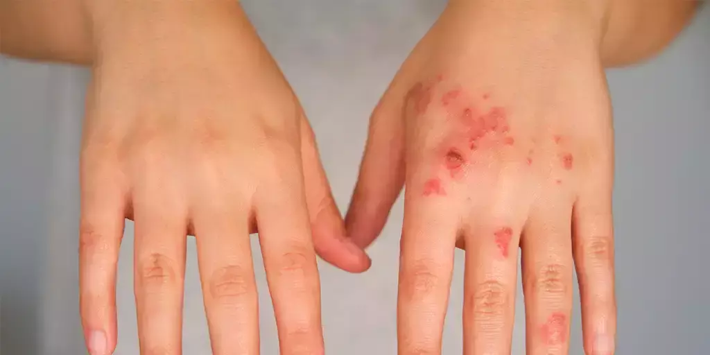 What is the best antibiotic to treat skin infections