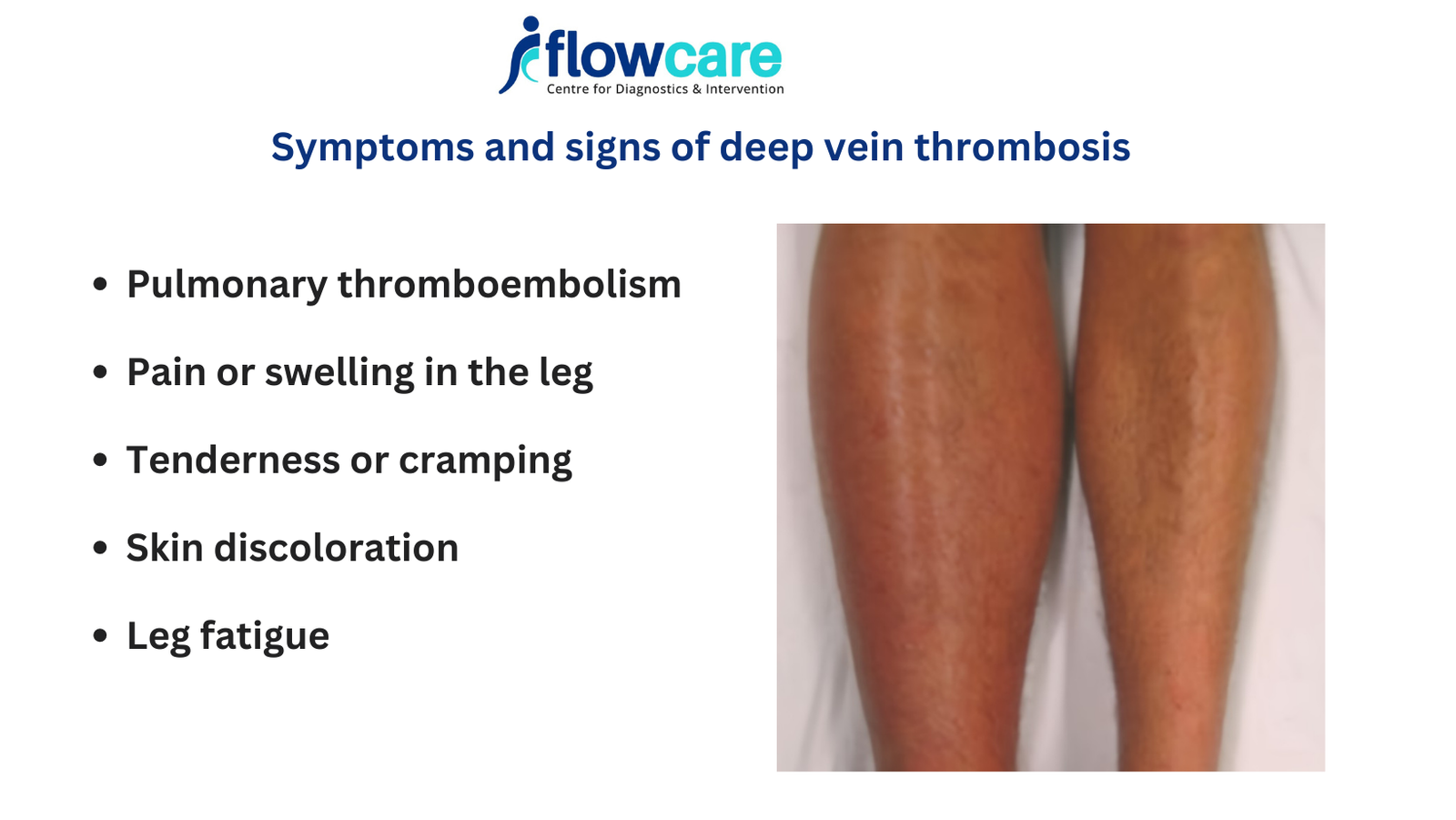 DVT symptoms