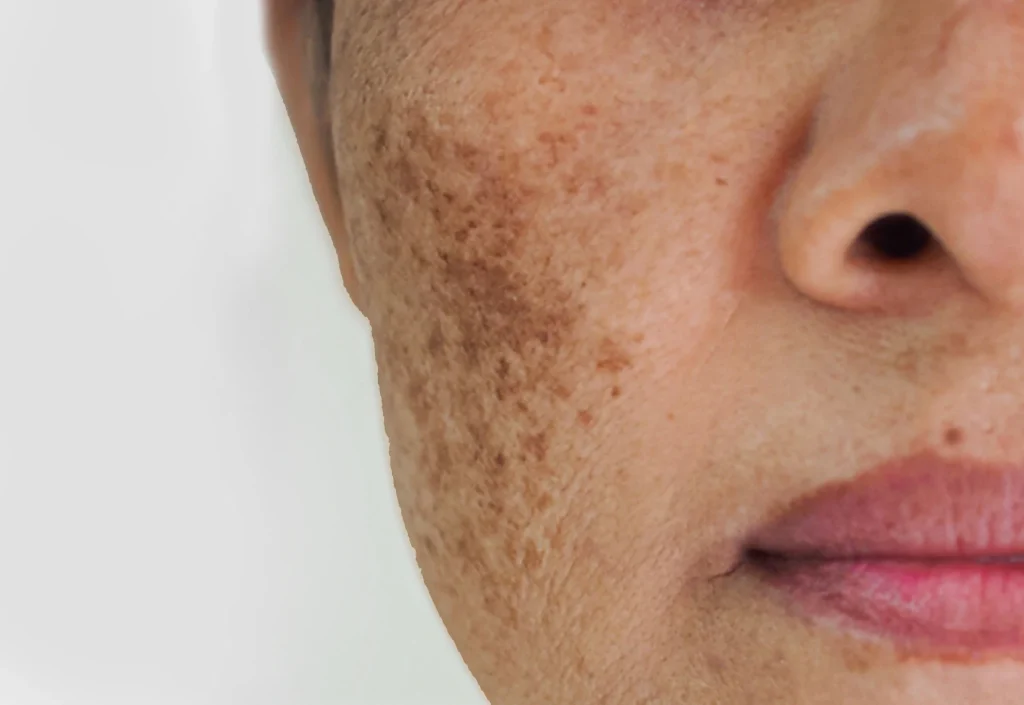 Discover Effective Dermal Pigmentation Solutions in Abu Dhabi