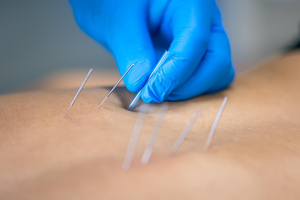 Dry Needling New York